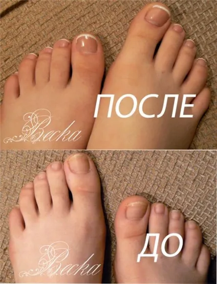 Нігті на ногах ростуть вгору - модна красива (ростуть) Нігті на ногах ростуть вгору - модна красива