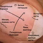 Визначення хвороби по нігтях (визначення хвороби нігтям) Визначення хвороби по нігтях