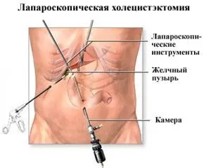 Операція з видалення жовчного міхура рекомендований харчування (харчування) Операція з видалення жовчного міхура рекомендований харчування