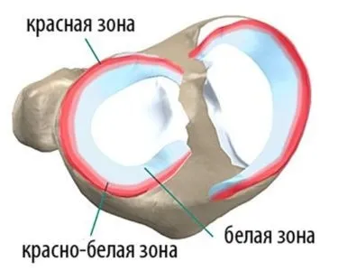 Операція на меніску колінного суглоба післяопераційна реабілітація