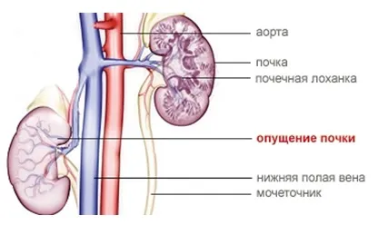 Опущення нирок - лікування народними засобами в домашніх умовах (опущення) Опущення нирок - лікування народними засобами в домашніх умовах