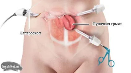 Операція при пупкової грижі види втручання, відгуки, ціни (фото) (грижі) Операція при пупкової грижі види втручання, відгуки, ціни (фото)