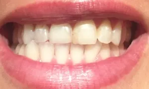 Відбілювання зубів за almea xsmile - fantastic beauty world