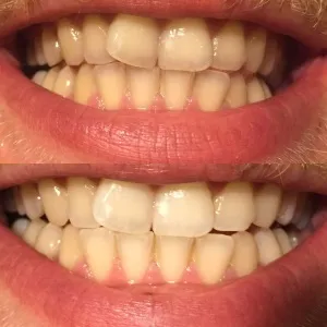 Відбілювання зубів за almea xsmile - fantastic beauty world