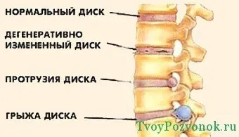 Остеохондроз шийного відділу і протрузія дисків, лікування шийного відділу (остеохондроз) Остеохондроз шийного відділу і протрузія дисків, лікування шийного відділу