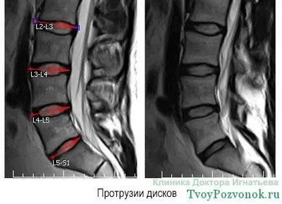 Остеохондроз шийного відділу і протрузія дисків, лікування шийного відділу (протрузія) Остеохондроз шийного відділу і протрузія дисків, лікування шийного відділу