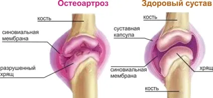Остеоартроз симптоми і лікування генералізованого остеоартрозу хребта і суглобів (лікування) Остеоартроз симптоми і лікування генералізованого остеоартрозу хребта і суглобів