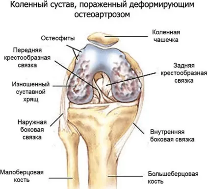Остеоартроз симптоми і лікування генералізованого остеоартрозу хребта і суглобів (симптоми) Остеоартроз симптоми і лікування генералізованого остеоартрозу хребта і суглобів