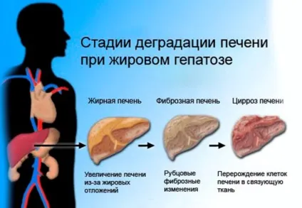 Ожиріння печінки симптоми, діагностика, лікування