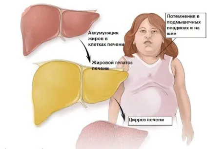 Ожиріння підшлункової залози, панкреатит (ожиріння підшлункової залози симптоми і лікування) Ожиріння підшлункової залози, панкреатит