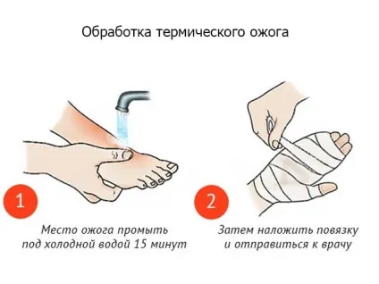 Опіки лікування в домашніх умовах фото і відео (умовах) Опіки лікування в домашніх умовах фото і відео