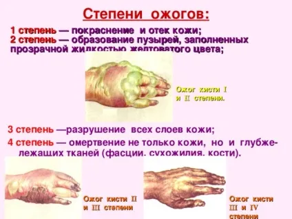 Опіки лікування в домашніх умовах фото і відео (умовах) Опіки лікування в домашніх умовах фото і відео