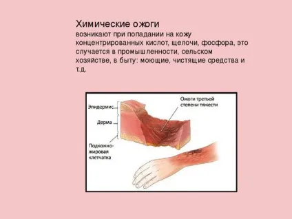 Опіки лікування в домашніх умовах фото і відео (лікування) Опіки лікування в домашніх умовах фото і відео