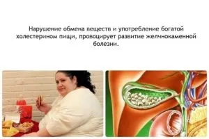 Пісок в жовчному міхурі симптоми, як вивести, лікування
