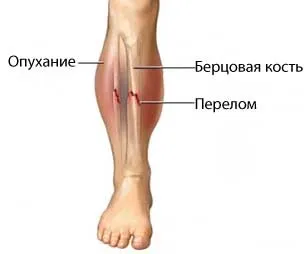 Перелом великогомілкової кістки зі зміщенням та без зміщення, лікування (зміщення) Перелом великогомілкової кістки зі зміщенням та без зміщення, лікування