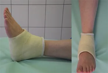 Перелом щиколотки зі зміщенням симптоми і лікування (перелом щиколотки зміщенням) Перелом щиколотки зі зміщенням симптоми і лікування