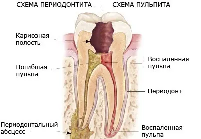 Періодонтит симптоми, лікування (лікування) Періодонтит симптоми, лікування