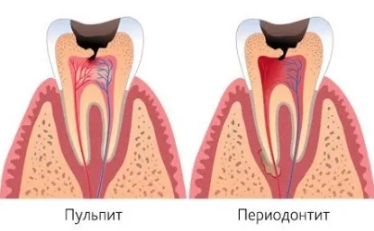 Періодонтит симптоми, лікування (лікування) Періодонтит симптоми, лікування