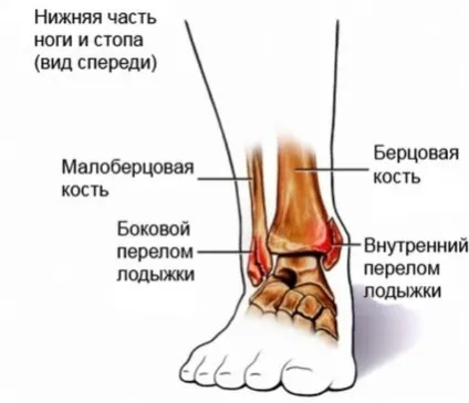 Перелом щиколотки зі зміщенням лікування і відновлення