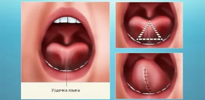 Пластика вуздечки язика лазером як підрізати її правильно (лазером) Пластика вуздечки язика лазером як підрізати її правильно