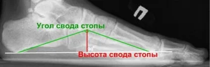 Плоскостопість 1-й, 2-й, 3-й, 4-го ступеня симптоми, види стадій (симптоми) Плоскостопість 1-й, 2-й, 3-й, 4-го ступеня симптоми, види стадій