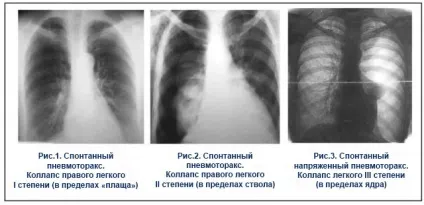 Пневмоторакс легкого причини, симптоми і лікування