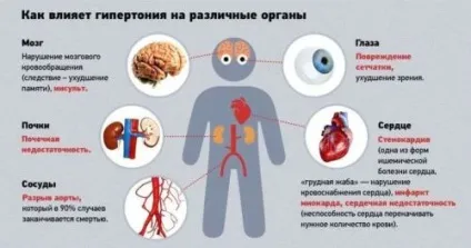 Ниркова гіпертонія симптоми, лікування артеріальної гіпертензії (гіпертонія) Ниркова гіпертонія симптоми, лікування артеріальної гіпертензії