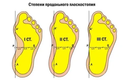 Плоскостопість 1-й, 2-й, 3-й, 4-го ступеня симптоми, види стадій (ступеня) Плоскостопість 1-й, 2-й, 3-й, 4-го ступеня симптоми, види стадій