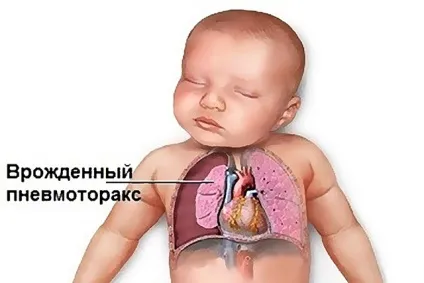 Пневмоторакс легкого причини, симптоми і лікування