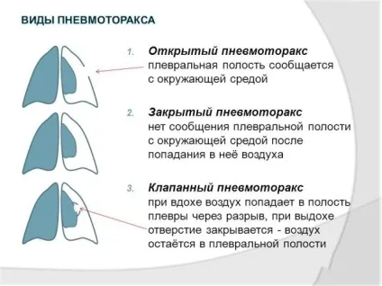 Пневмоторакс легкого причини, симптоми і лікування