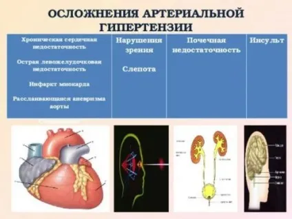 Ниркова гіпертонія симптоми, лікування артеріальної гіпертензії (гіпертонія) Ниркова гіпертонія симптоми, лікування артеріальної гіпертензії