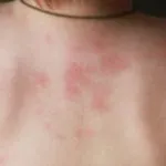 Чому з'являються білі плями на обличчі - поширені хвороби (білі) Чому з'являються білі плями на обличчі - поширені хвороби