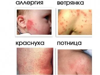Чому з'являється пітниця на обличчі у немовляти (пітниця) Чому з'являється пітниця на обличчі у немовляти