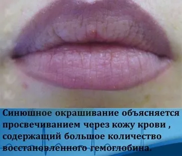 Чому синіють губи у дорослого і дитини можливі захворювання, коли потрібна допомога лікаря - здоров'я (дорослого) Чому синіють губи у дорослого і дитини можливі захворювання, коли потрібна допомога лікаря - здоров'я
