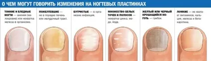 Чому шаруються нігті на руках і ногах причини ламкості нігтів