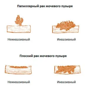 Поліпи в сечовому міхурі у чоловіків, жінок лікування, симптоми (міхурі) Поліпи в сечовому міхурі у чоловіків, жінок лікування, симптоми