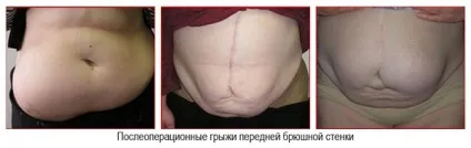 Післяопераційна вентральна грижа живота що це таке, причини, лікування (післяопераційна) Післяопераційна вентральна грижа живота що це таке, причини, лікування