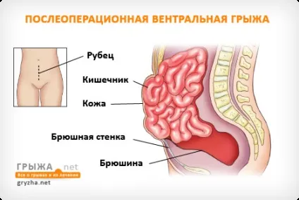 Післяопераційна вентральна грижа причини виникнення ускладнень