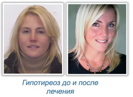 Наслідки аутоімунного тиреоїдиту чого очікувати