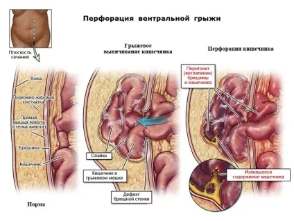 Післяопераційна вентральна грижа живота що це таке, причини, лікування (вентральна грижа післяопераційний період) Післяопераційна вентральна грижа живота що це таке, причини, лікування