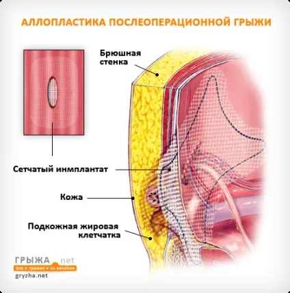 Післяопераційна вентральна грижа причини виникнення ускладнень