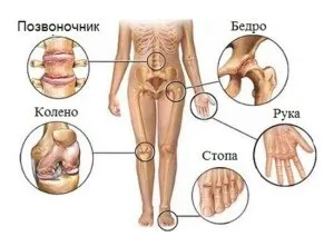 Правильне лікування при поліартриті