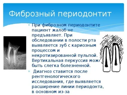 Презентація по темі періодонтит (презентація) Презентація по темі періодонтит