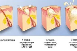 Прищі на мошонці у чоловіків (прищі) Прищі на мошонці у чоловіків