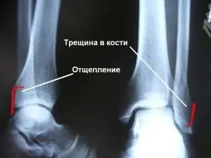 Причини, симптоми і методи лікування тріщини в кістки - відео - «все до дрібниць» (тріщини) Причини, симптоми і методи лікування тріщини в кістки - відео - «все до дрібниць»