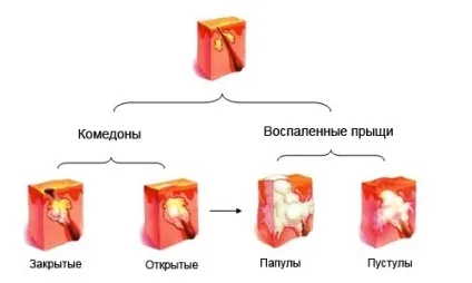 Прищі на мошонці у чоловіків (Білі прищі яйцях) Прищі на мошонці у чоловіків