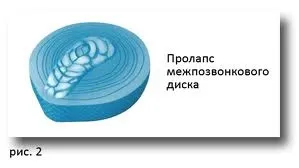 Пролапс диска хребта, мій хребет