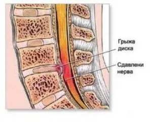 Пролапс міжхребцевого диска - що це