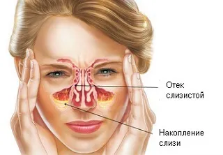 Профілактика гаймориту домашні способи і ліки (способи) Профілактика гаймориту домашні способи і ліки