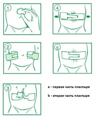 Пупкова грижа у дітей (фото)
